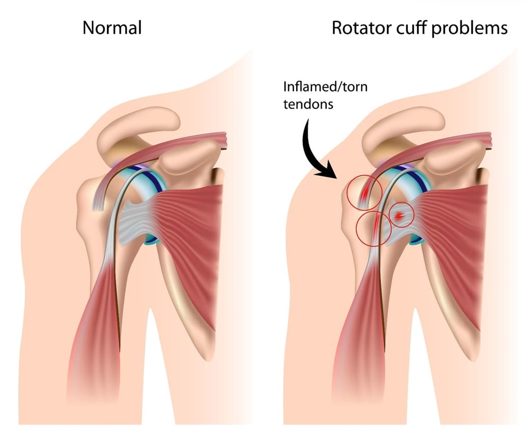 Rotator cuff tears