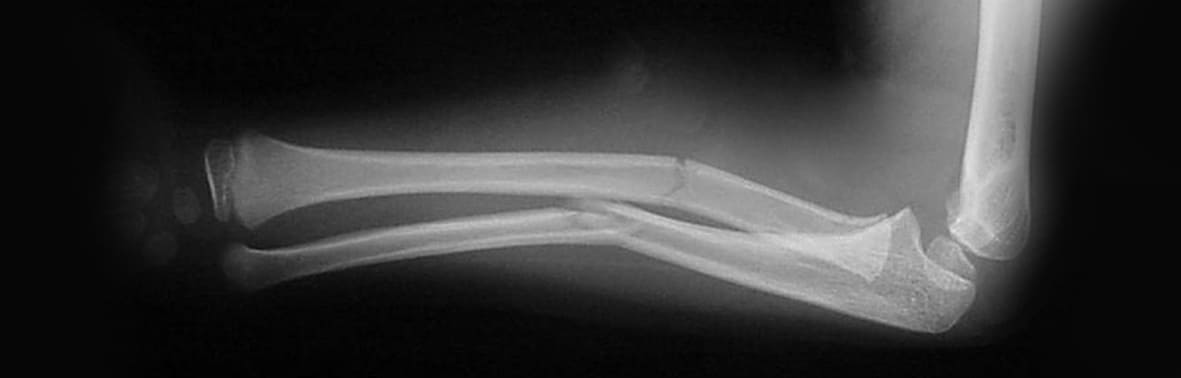 fracture