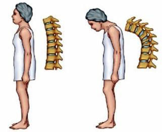 symptoms of osteoporosis