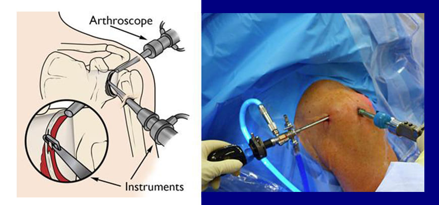 Shoulder Arthroscopy